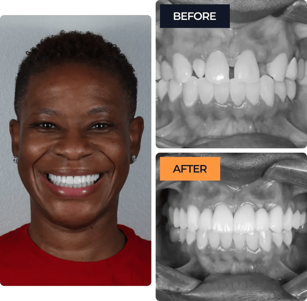 Detailed comparison of a smile makeover: clinical "Before" shots showing tooth spacing and "After" shots featuring a perfectly aligned, bright white smile with porcelain veneers on a happy female patient.